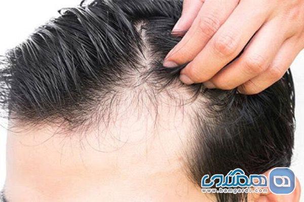 کرونا و معمای ریزش موی سر کرونا و معمای ریزش موی سر